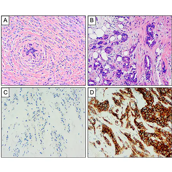invasive lobular carcinoma